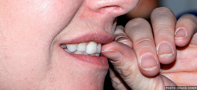 Nail Biting Can Harm Your Teeth