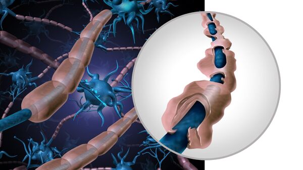 При рассеянном склерозе клетки иммунной системы разрушают защитную оболочку (бежевую) нервных отростков (синих). Это приводит к сбоям в работе центральной нервной системы