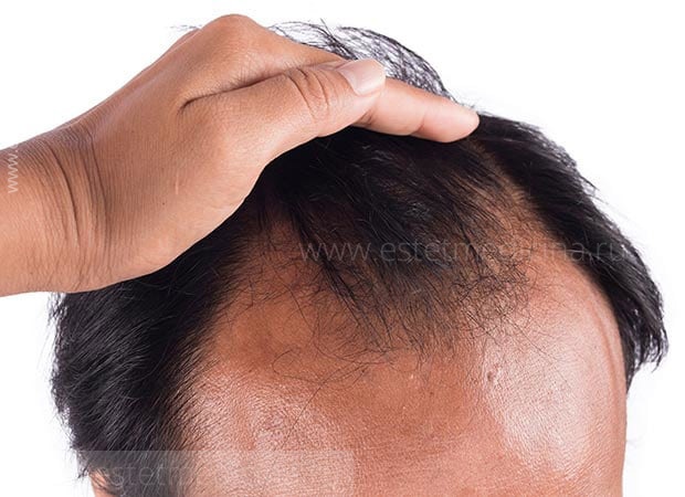 редеют волосы у мужчины