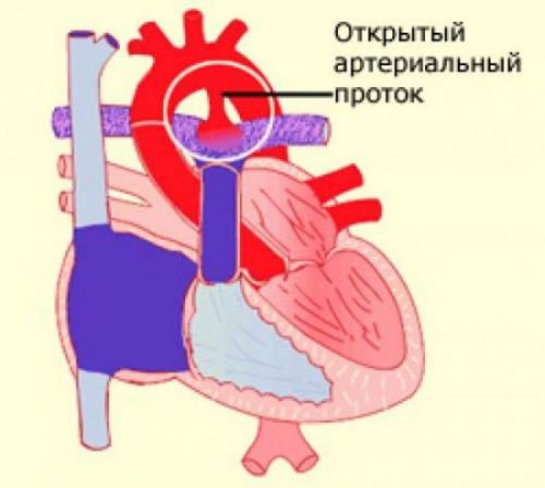 Открытый артериальный проток