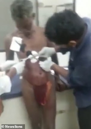 A video shows the moment that two doctors go about trying to remove it, with Mr Lakhma watching quietly