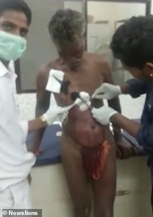 Indian man Madhvi Lakhma travelled 60 miles to hospital to have an arrow removed from his chest after he was attacked by two men at his home in Sukma district in Chhattisgarh, central India