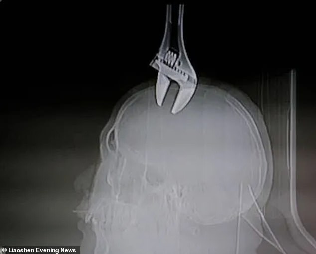 The six-inch sharp tool was accidentally dropped by a maintenance worker who was installing an air conditioner outside a flat eight-storeys up in north-eastern Chinese province Liaoning, reported local press. The mechanical tool can be seen in an X-ray scan stuck in the man’s head