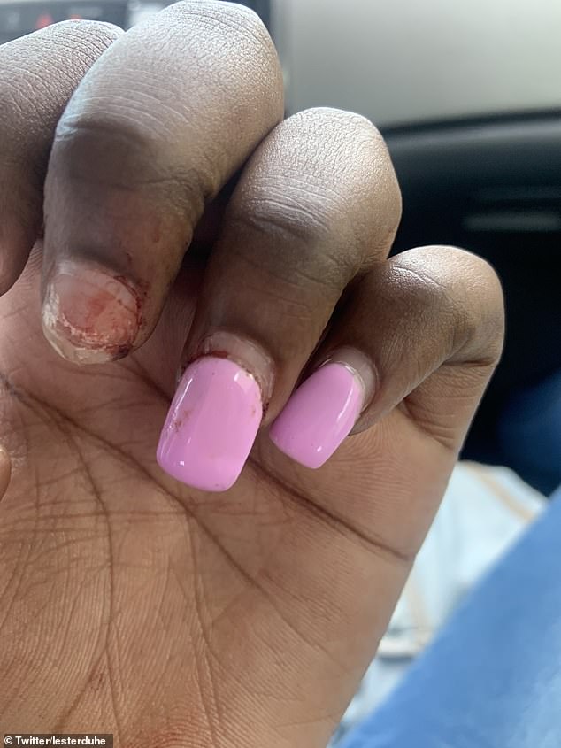 The teen also suffered several broken nails