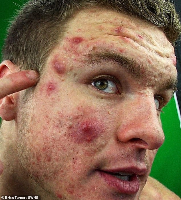 Agonizing: The 27-year-old says his acne began when he began eating and drinking huge quantities of dairy to try and bulk up his muscles - but he didn