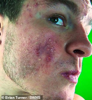 Self conscious: Painful cysts erupted on Brian