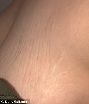 Before (left) and after (right). The young woman noticed no change in the appearance of her stretch marks after the treatment 