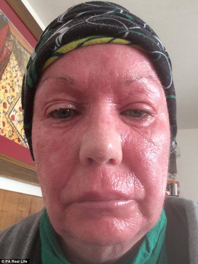 To help her skin, Ms Coward took steroid creams in her 20s but panicked if she ran out&nbsp;