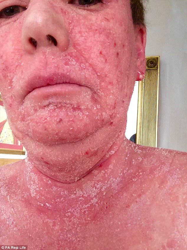 Ms Coward was given topical steroids for her eczema as a baby (pictured during withdrawal)