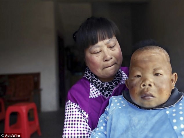 His mother, 52-year-old Chu Xiaoping (pictured holding Tianfang) said her son stopped growing between two and three years old and his intelligence stopped developing too