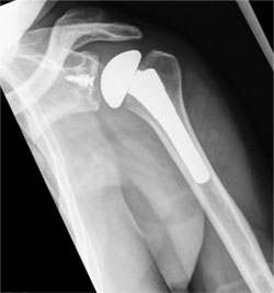 X-ray showing anatomic total shoulder replacement.