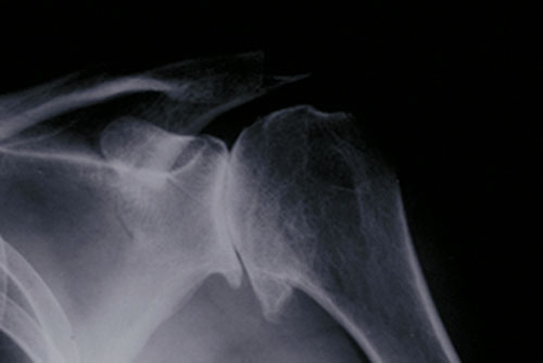X-ray showing osteoarthritis of the shoulder joint.