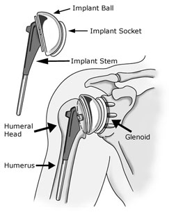 Anatomy of the shoulder area, depicting the implant after surgery, labeled to show implant ball, implant socket, implant stem, the humerus, humeral head and glenoid.